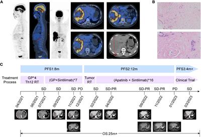 Case Report: A novel mixture of dose-fractioned radiation and immunotherapy for treatment of cholangiocarcinoma